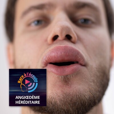 Maladie rare – Accompagner les patients atteints d’angiœdème héréditaire : focus sur l’éducation thérapeutique